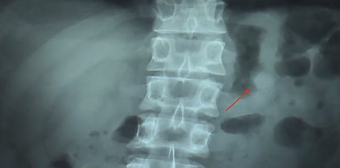 Muž spolkl AirPods. Divil se tomu, že v žaludku stále fungovaly